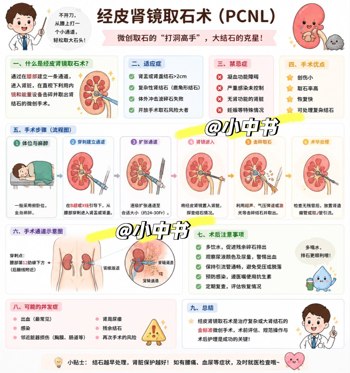 🪨经皮肾镜取石术（PCNL）｜临床速记：肾结石的“打洞取石术”